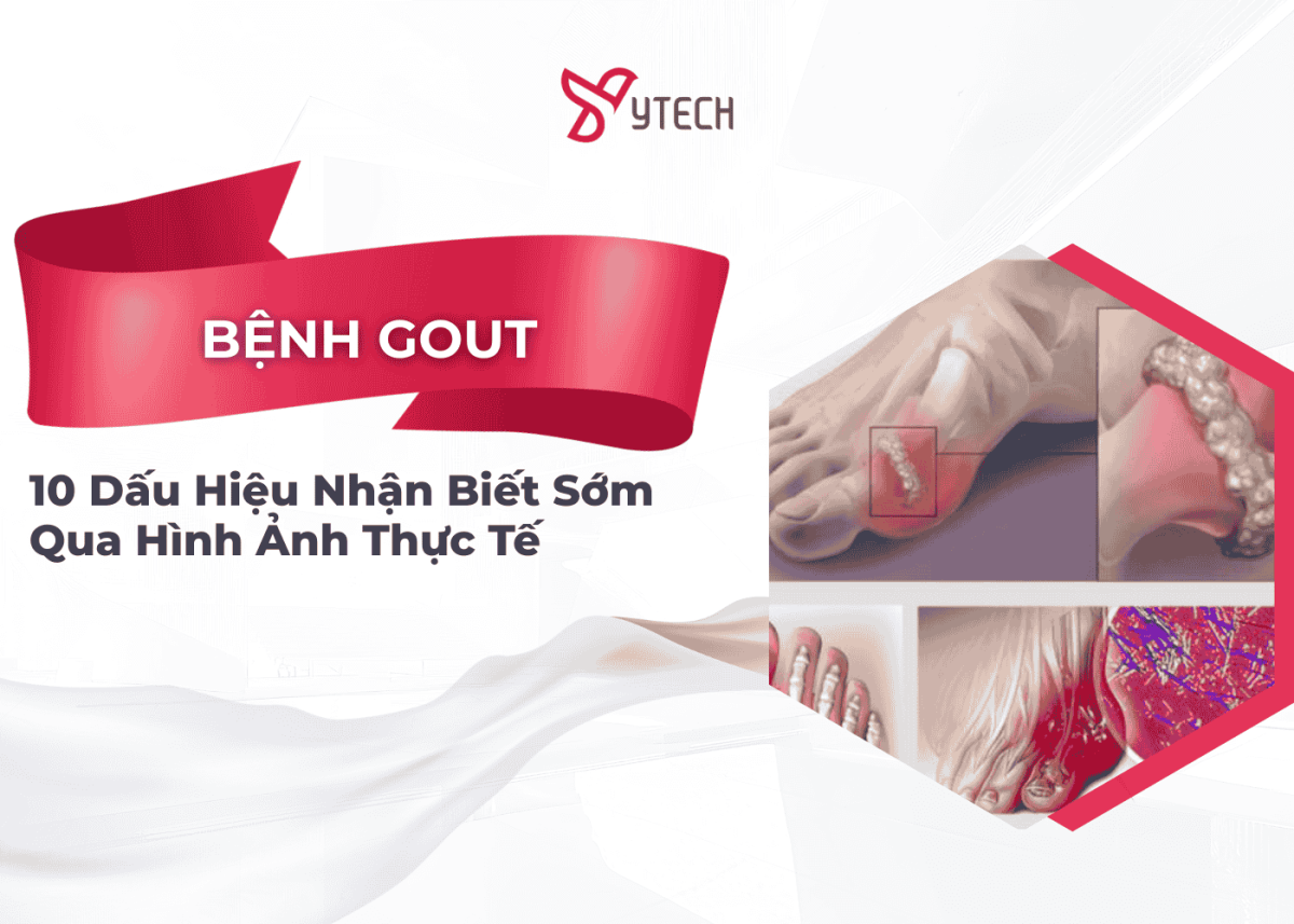 10 DẤU HIỆU BỆNH GOUT ĐIỂN HÌNH NHẤT NHẬN BIẾT SỚM QUA HÌNH ẢNH THỰC TẾ