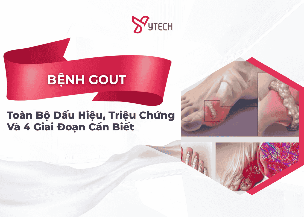 BỆNH GOUT (GÚT) LÀ GÌ? CÁC DẤU HIỆU, TRIỆU CHỨNG VÀ 4 GIAI ĐOẠN CẦN BIẾT