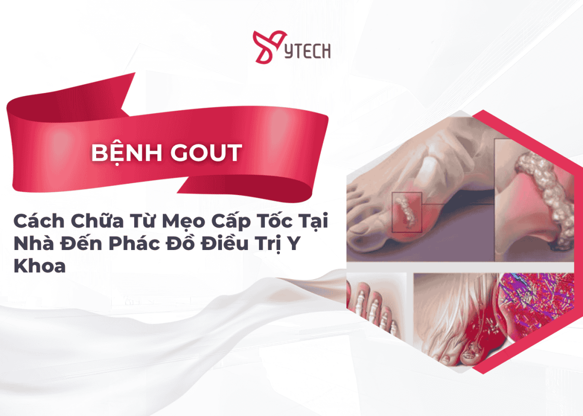 CÁCH CHỮA BỆNH GÚT HIỆU QUẢ TỪ MẸO CẤP TỐC TẠI NHÀ ĐẾN PHÁC ĐỒ ĐIỀU TRỊ Y KHOA