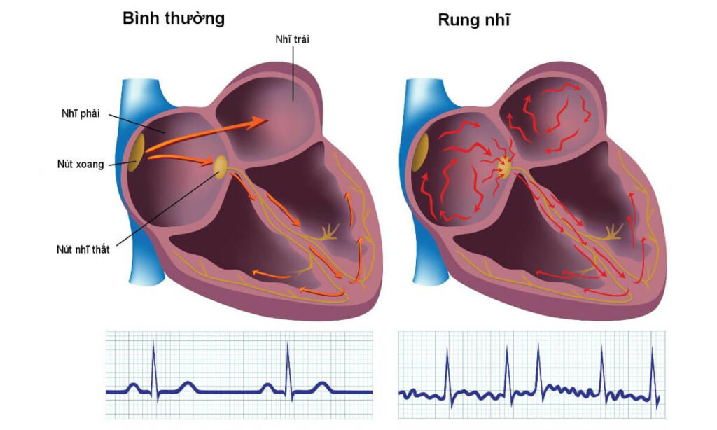 Có thể phát hiện ra các dấu hiệu cảnh báo bệnh Rung Tâm Nhĩ (Afib) được không?