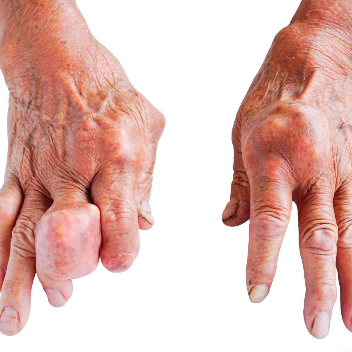 10 DẤU HIỆU BỆNH GOUT ĐIỂN HÌNH NHẤT NHẬN BIẾT SỚM QUA HÌNH ẢNH THỰC TẾ