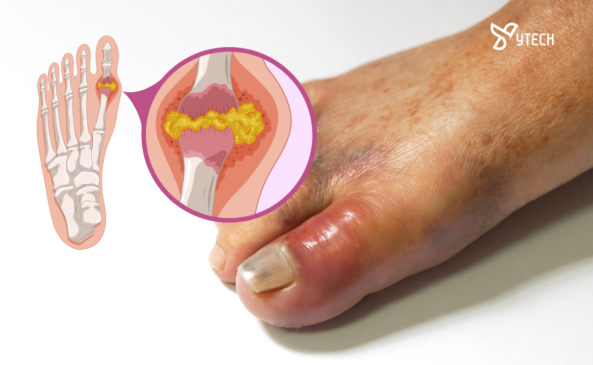 BỆNH GOUT (GÚT) LÀ GÌ? CÁC DẤU HIỆU, TRIỆU CHỨNG VÀ 4 GIAI ĐOẠN CẦN BIẾT