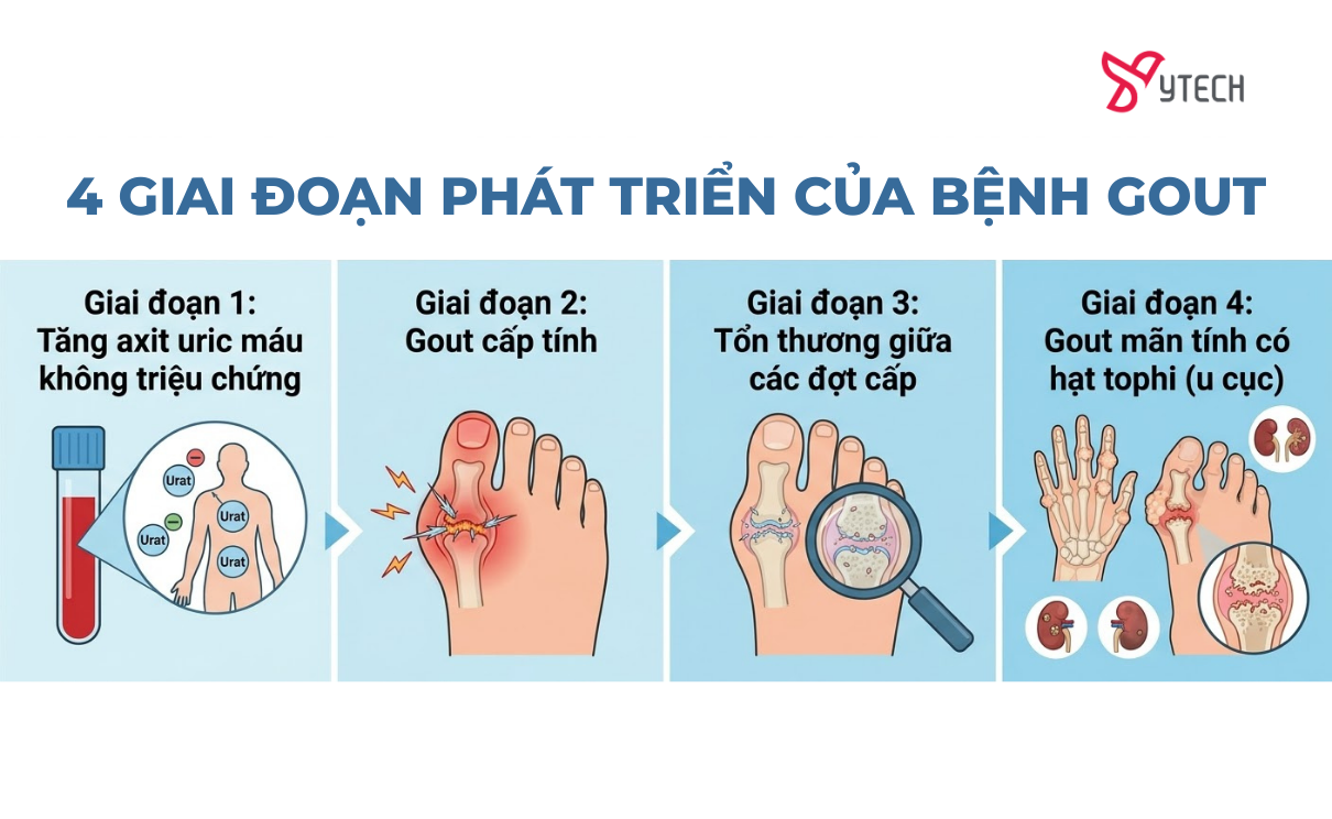 BỆNH GOUT (GÚT) LÀ GÌ? CÁC DẤU HIỆU, TRIỆU CHỨNG VÀ 4 GIAI ĐOẠN CẦN BIẾT