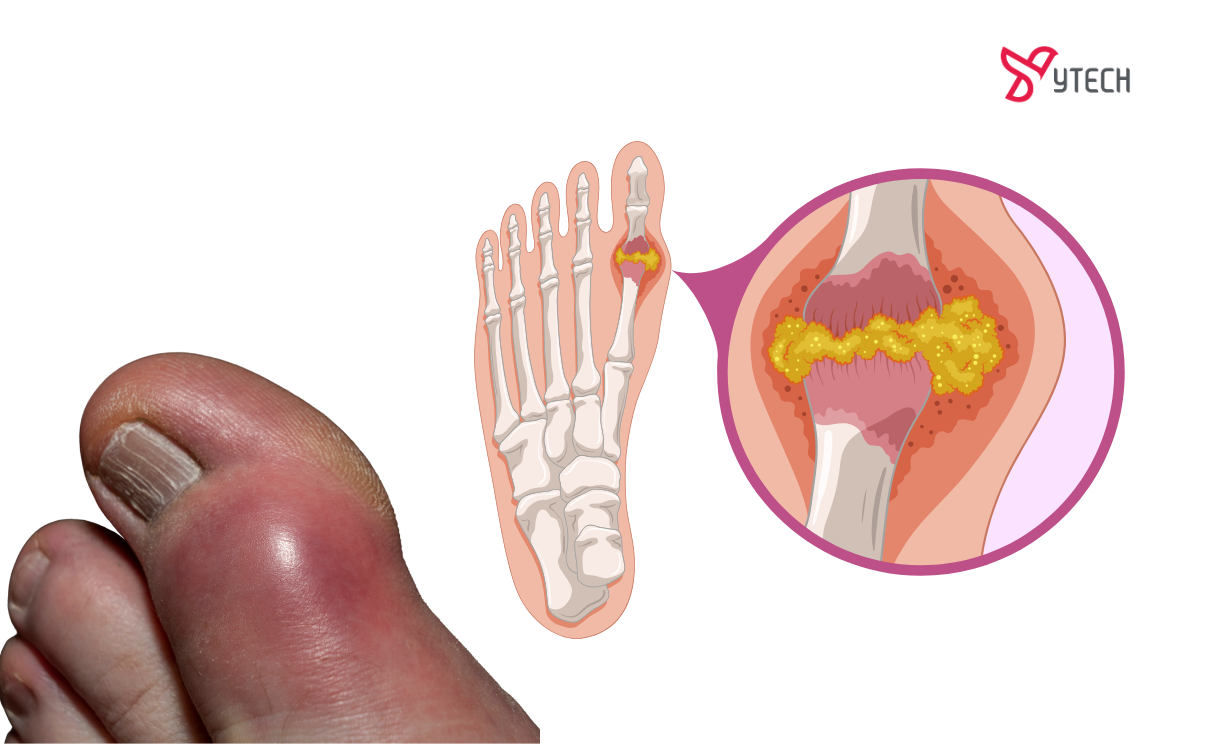 BỆNH GOUT (GÚT) LÀ GÌ? HƯỚNG DẪN CHI TIẾT CÁCH PHÂN BIỆT GOUT VÀ VIÊM KHỚP ĐỂ TRÁNH SAI LẦM NGUY HIỂM