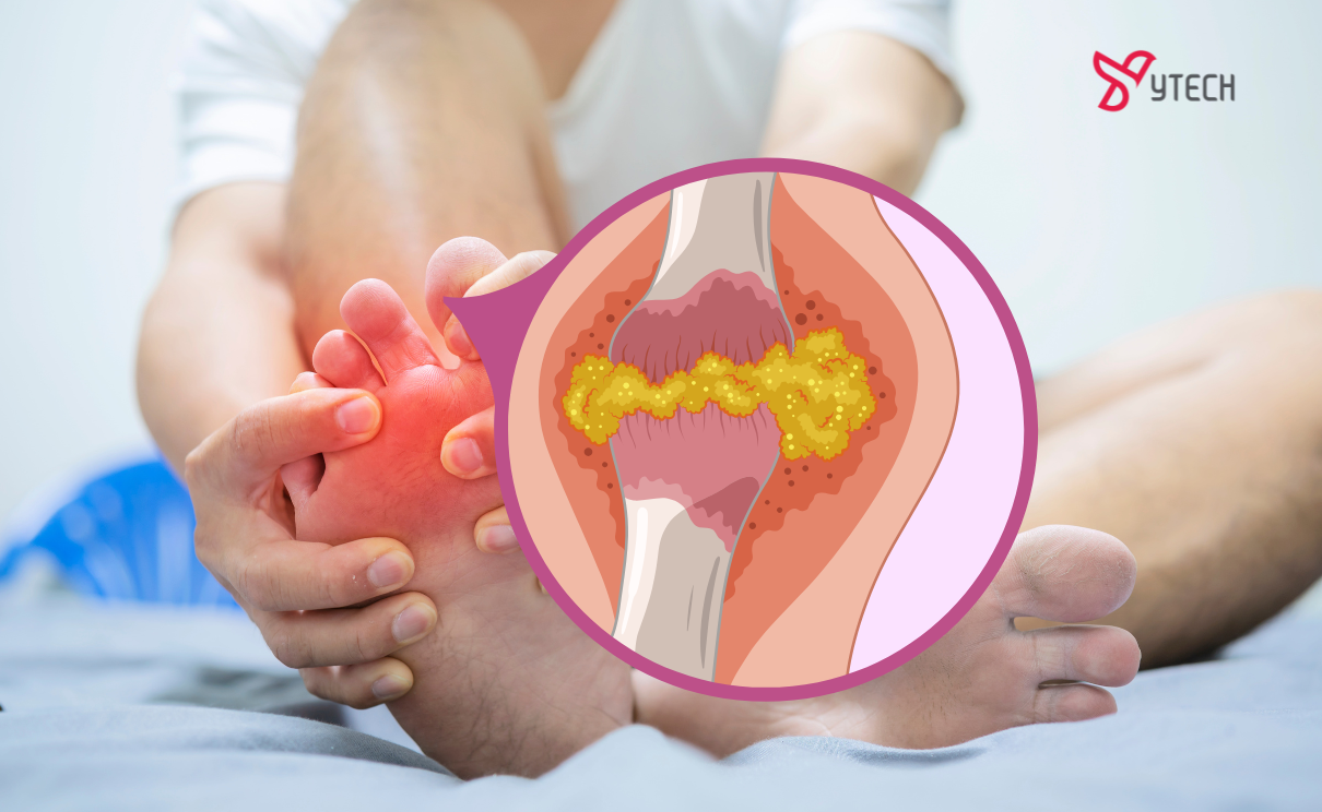 TỔNG HỢP A-Z CÁC CÁCH CHỮA BỆNH GOUT HIỆU QUẢ & AN TOÀN NHẤT 2026