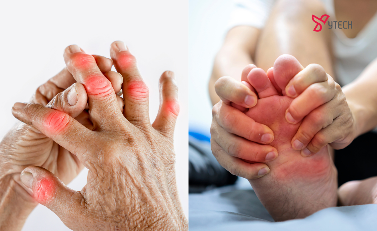 BẬT MÍ 7 CÁCH CHỮA BỆNH GOUT TẠI NHÀ BẰNG DÂN GIAN CỰC HIỆU QUẢ, GIẢM ĐAU NHANH CHÓNG