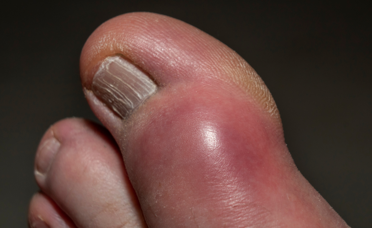 CHỈ SỐ AXIT URIC BAO NHIÊU LÀ CAO? LÀM SAO ĐỂ BIẾT MỨC AN TOÀN VÀ NGUY HIỂM TẠI NHÀ