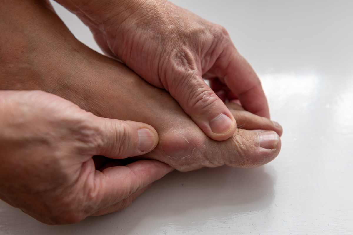 CÁCH CHỮA BỆNH GÚT HIỆU QUẢ TỪ MẸO CẤP TỐC TẠI NHÀ ĐẾN PHÁC ĐỒ ĐIỀU TRỊ Y KHOA