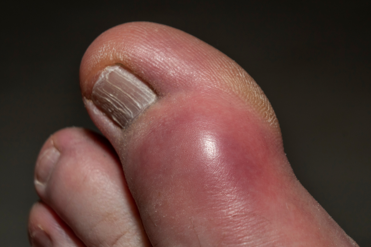 Biến chứng bệnh gout gây đau viêm khớp cổ chân và cần chẩn đoán sớm&nbsp;