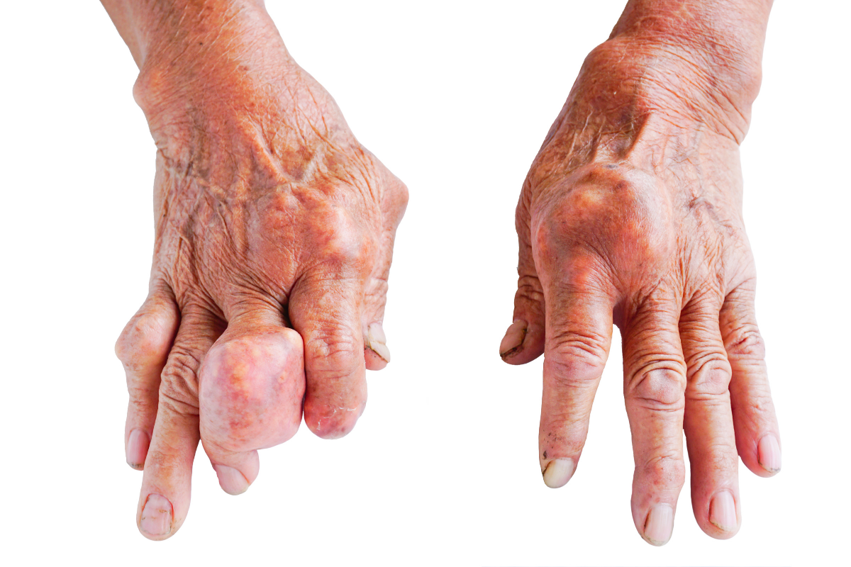 Hạt tophi hình thành ở bàn tay của bệnh nhân gout.