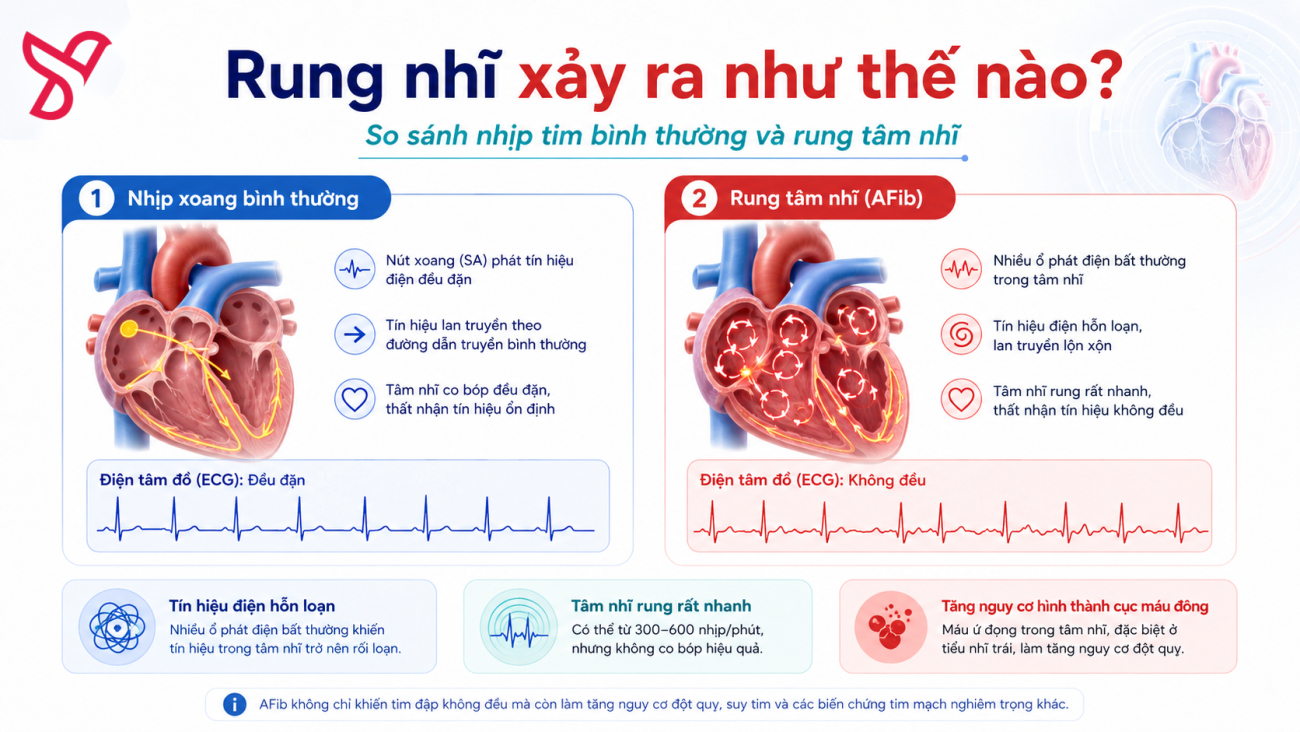 So sánh nhịp tim bình thường và rung tâm nhĩ