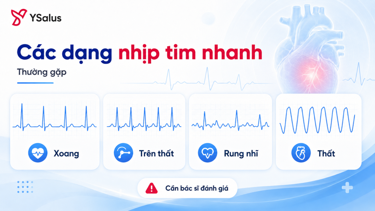 Các dạng nhịp tim nhanh thường gặp