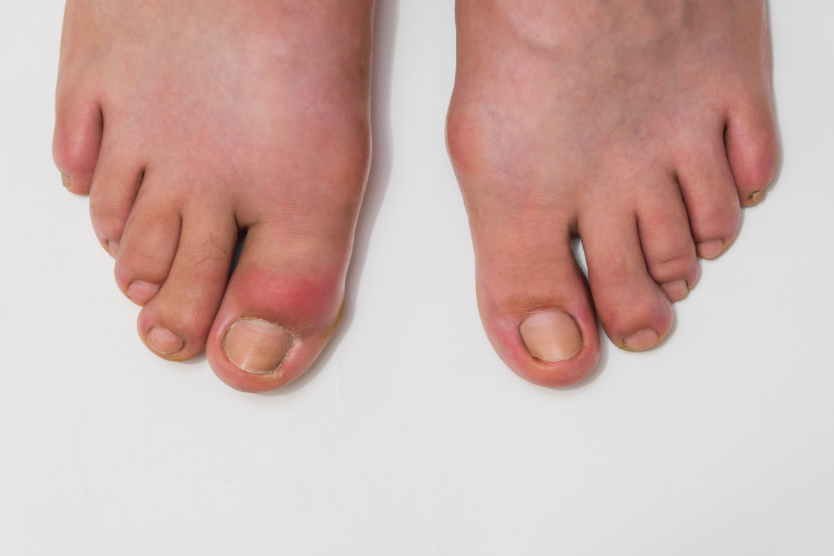 Cơn gout cấp tính gây sưng đỏ, nóng rát, đau dữ dội.