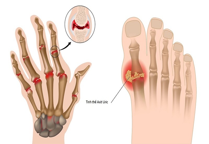 Mối liên hệ giữa axit uric, tinh thể urat và triệu chứng bệnh gout tại khớp