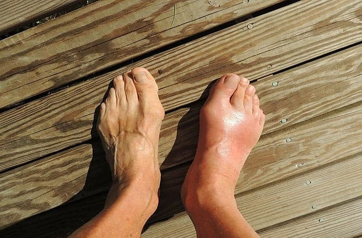 Khớp ngón chân cái sưng đỏ là một trong những triệu chứng bệnh gout thường gặp