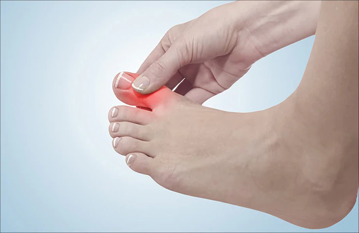 So sánh dấu hiệu gout cấp với viêm khớp dạng thấp và viêm khớp nhiễm khuẩn