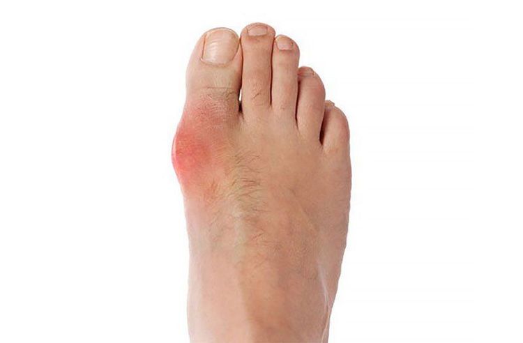 Triệu chứng bệnh gout cấp với khớp ngón chân cái sưng đỏ và đau
